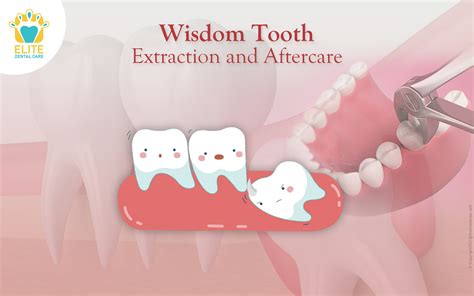 Tooth Extraction: What You Need To Know .